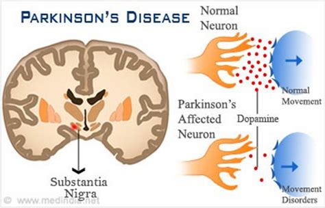 what part of the brain causes parkinson's